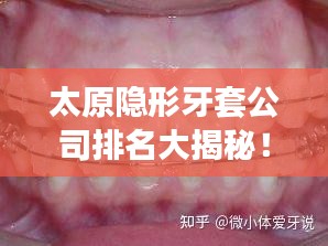 太原隐形牙套公司排名大揭秘！专业矫正牙齿，打造自信笑容！